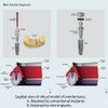 MDLMOR10Z MDLORZ Replacement O Ring Kit, for Intralock Mini Implant