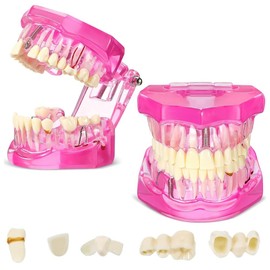 RETROGOO Disease Teeth Model Dental Typodonts Implant Teeth Model with Removable Teeth Pathological Demonstration (Pink,2 Pcs)