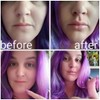 Full Lip Suction, Lip Improvement, Lip Impact Suction, Lip Enhancer
