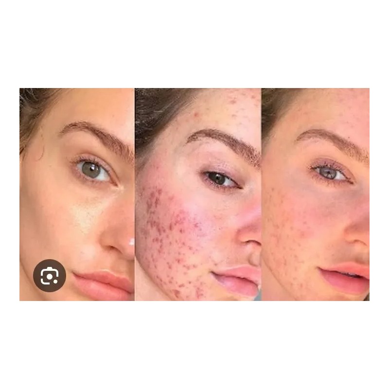 Gel Sabila 99% Facial Aclarante Cicatriz Cara Y Cuerpo Normal