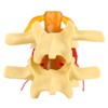 1:1.5 Anatomical Medical Human Spine Lumbar Disc Herniation Demonstration Model