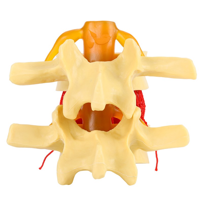 1:1.5 Anatomical Medical Human Spine Lumbar Disc Herniation Demonstration Model