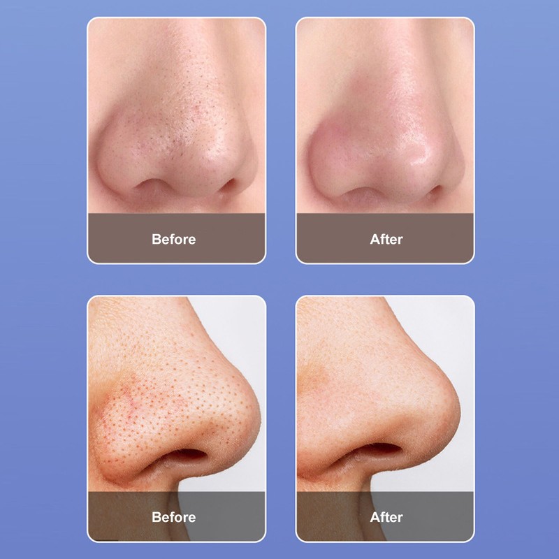 Facial Oxygen Injector 3 Gears 6 Suction Heads Vacuum Negative