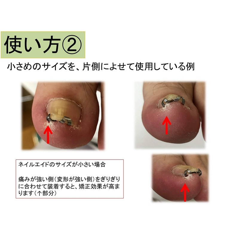 Nail Aid 0.6 inch (14 mm) Winding Nail Correction Self-Winding
