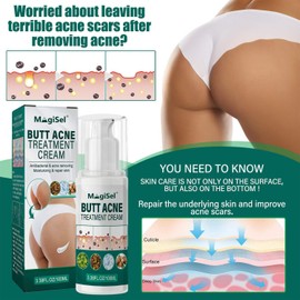 Creme zur Entfernung von Mitessern am Gesäß, Arschcreme, Akne-Entferner Am Gesäß, Creme zur Entfernung von Mitessern Am Gesäß,Akne-Gluteus-Behandlung,Creme zur Behandlung von Gluteekorn, 100ml