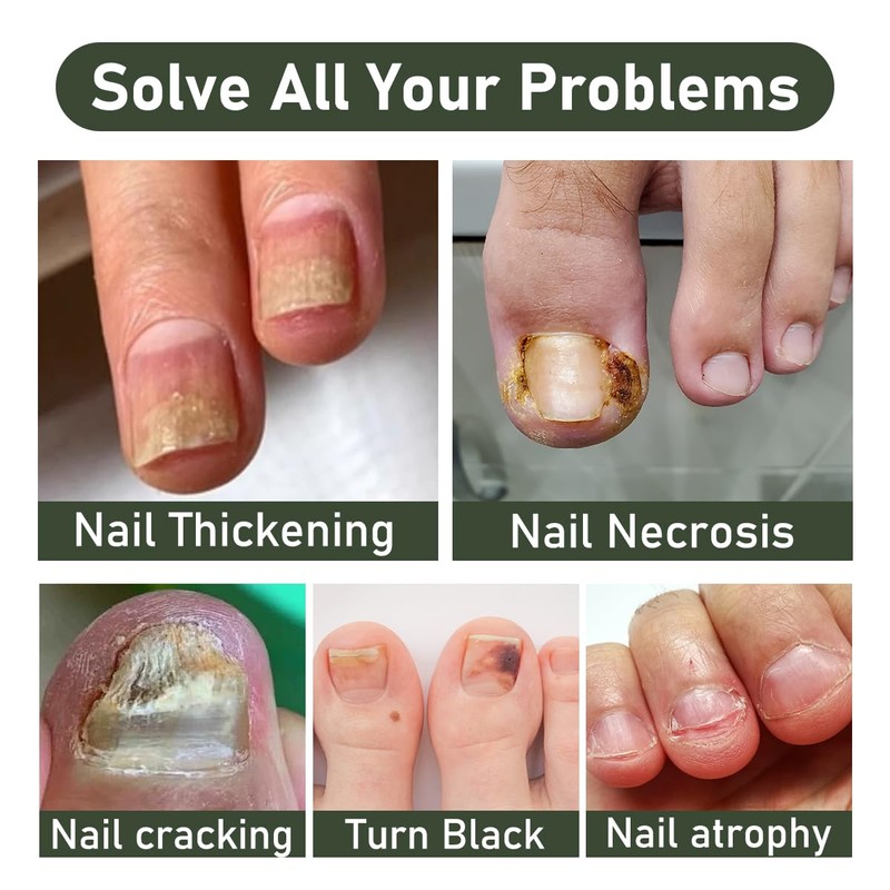 2PCS Ginger Nail Serum Solution, Ginger Cuticle Care Oil for