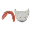 Dental Implant Teeth Restoration Model Mandibular Overdenture with 2 Implants