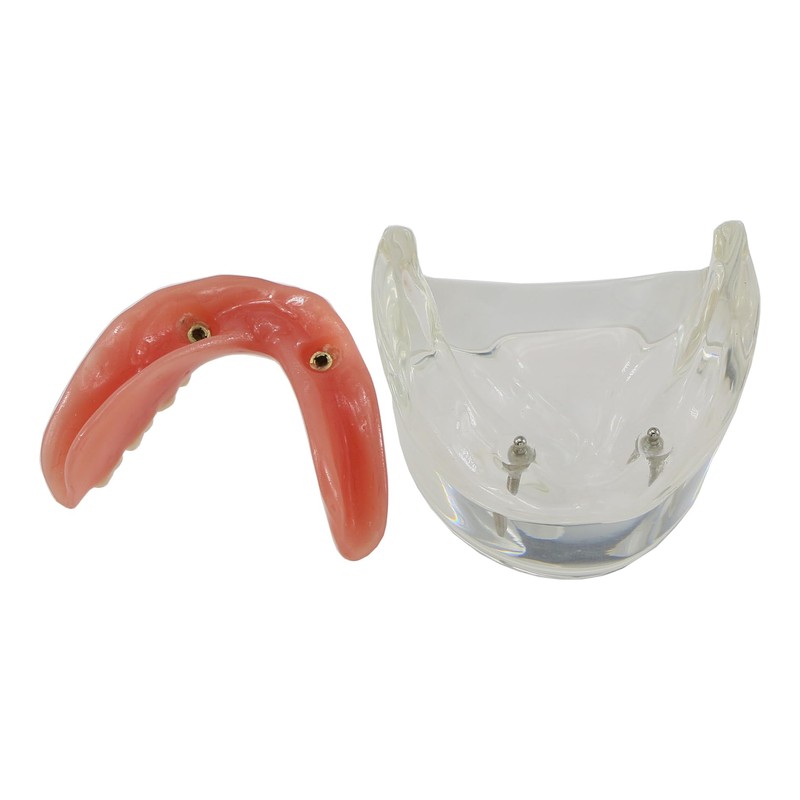 Dental Implant Teeth Restoration Model Mandibular Overdenture with 2 Implants