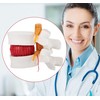 Human Lumbar Disc Herniation Model, 1.5 Times Durable and Lightweight