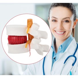 Human Lumbar Disc Herniation Model, 1.5 Times Durable and Lightweight Human Lumbar Disc Model, Visualized Anatomy of Lumbar Disc Herniation, Applied in Learning, Teaching, and Display