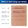 Silicone Scar Sheets for Surgical Scars: Silicone Gel Sheets for