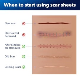 Silicone Scar Sheets for Surgical Scars: Silicone Gel Sheets for Keloids, Burns, Abrasion and C-Section - Safe for Adults and Children - Breathable, Skin-Friendly and Waterproof Silicone Tape 4PCS