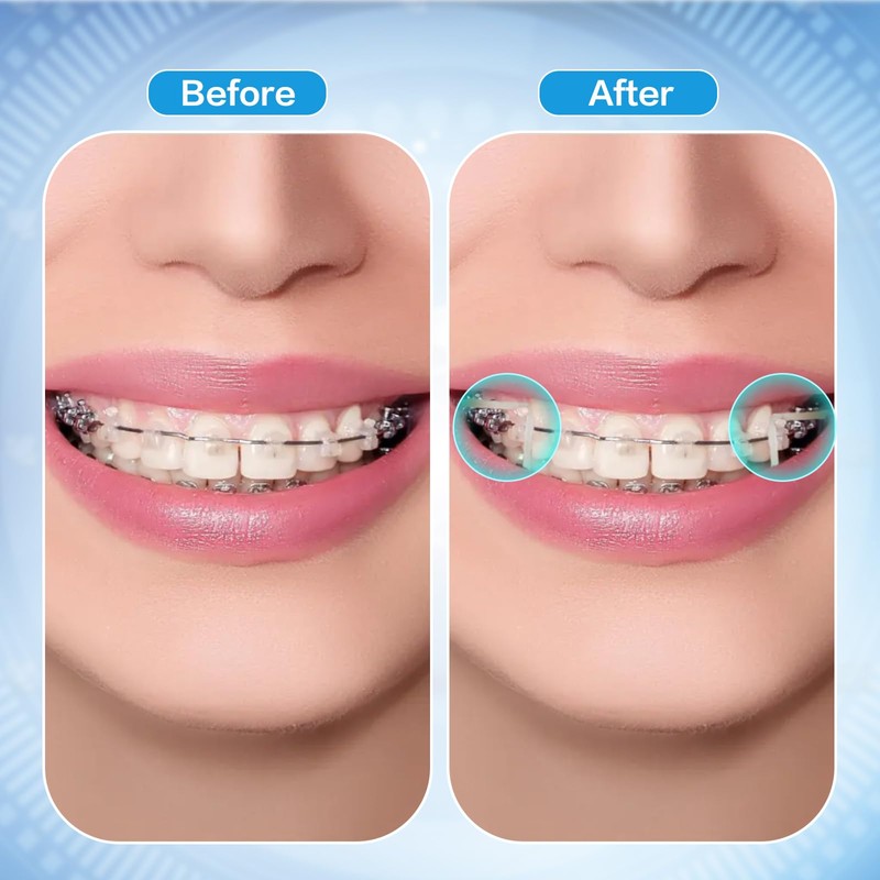 Xumann 300 PCS Orthodontic Elastic Bands, Braces Band for Dentist