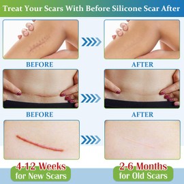 Silicone Scar Sheets, Medical Grade Silicone Scar Tape (1.6"x 158"), Reusable Removal Improve Strips for Surgical C-Section, Keloid, Tummy Tuck, Burn, Acne, Surgery