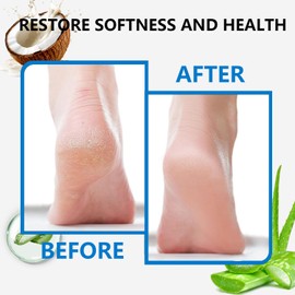 Urea Foot Cream, 42 Urea Cream Cracked Heel Repair Cream for Feet and Hand Foot Cream for Callus Remover & Nourishes Soften for Hand Foot and Body Care, 100g
