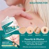 Crema Removedora Eficaz Mezquinos Verrugas Lunares Sin Dolor