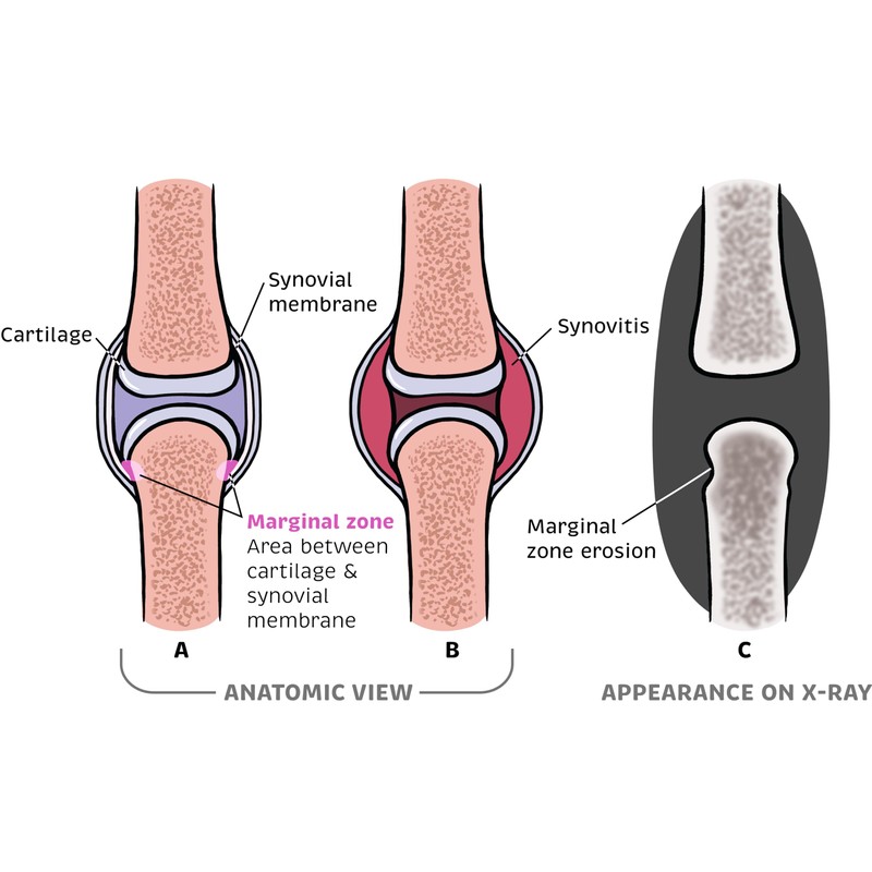 Rheumatology Made Ridiculously Simple