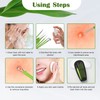 FVION 5 Pieces Blackhead Remover, Comedone Squeezer Set, Pimple Squeezing