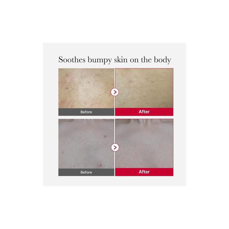 MEDICUBE [MEDICUBE]Red Acne Body Peeling Shot 2.0 110g