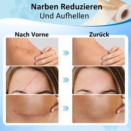 CAIJ Silikon-Narbenband (4CMX3M), Silikon-Narbenfolie, Professionelle Silikon-Narbencreme für Chirurgische Narben, Keloide, Kaiserschnitt, Bauch, Verbrennungen, Akne, etc.