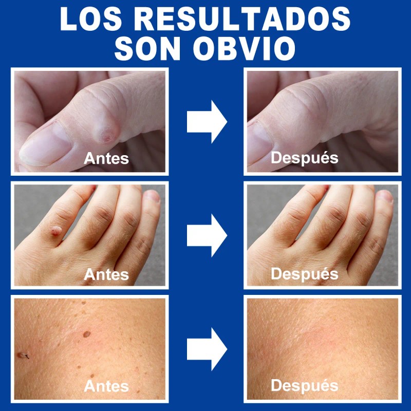 Líquido De Eliminación De Verrugas Plantar Y Comunes 1pc