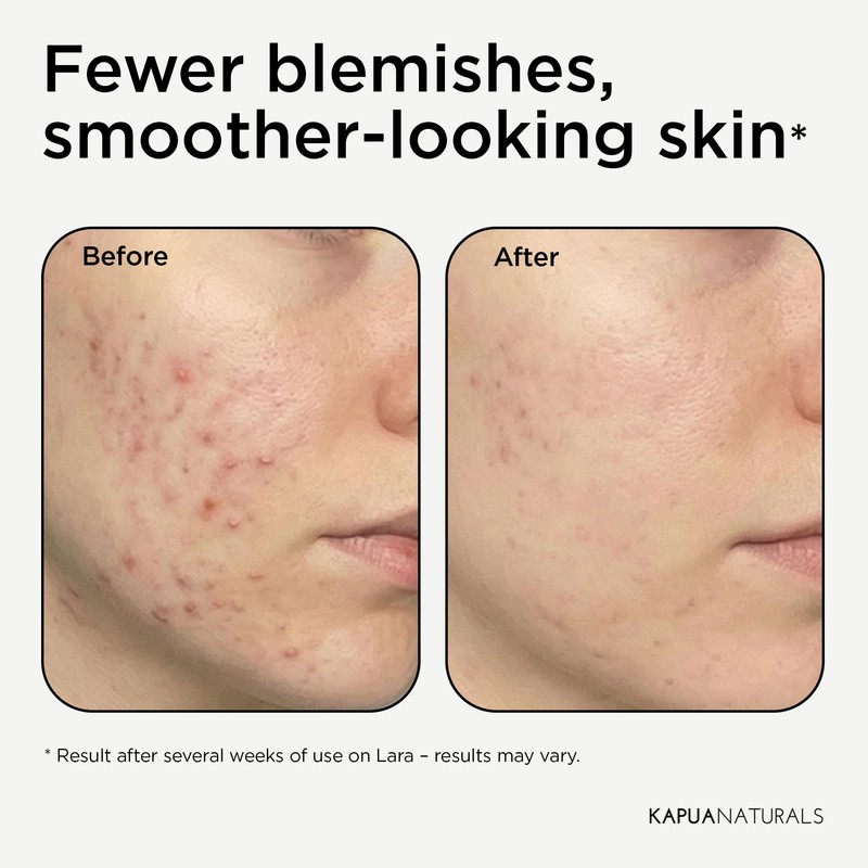 BHA Peeling 2% (100 ml) – Face Peel with BHA