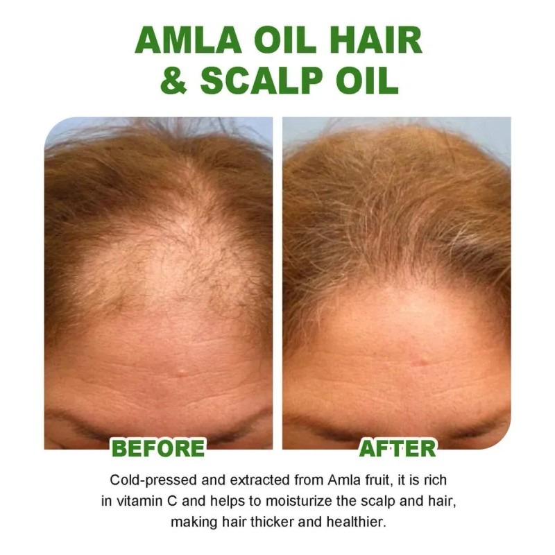 Mzl Aceite Capilar Amla Oil For Crecimiento Cabello
