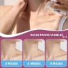 Scar Gel Vogsig Elimina Cicatrices Queloide Abdominoplastia