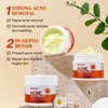 Acne Cream Multi-Acid Deep Relief – 4% Lactic Acid BHA/AHA