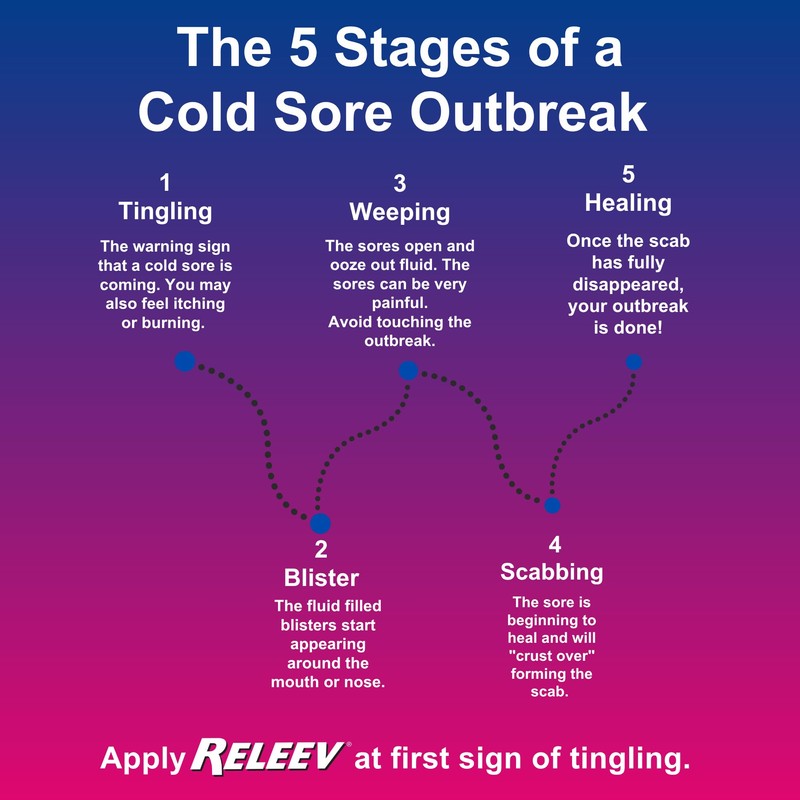 Releev 1 Day Cold Sore Symptom Treatment, 6 mL (0.20