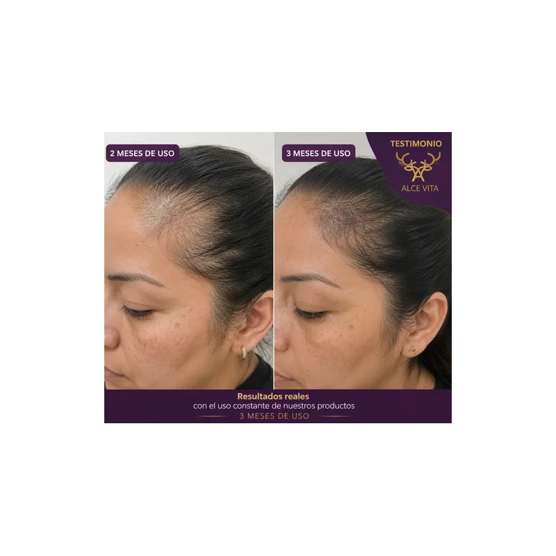 1 Shampoo Anticaída Y Crecimiento Chile Y Romero Vital Root