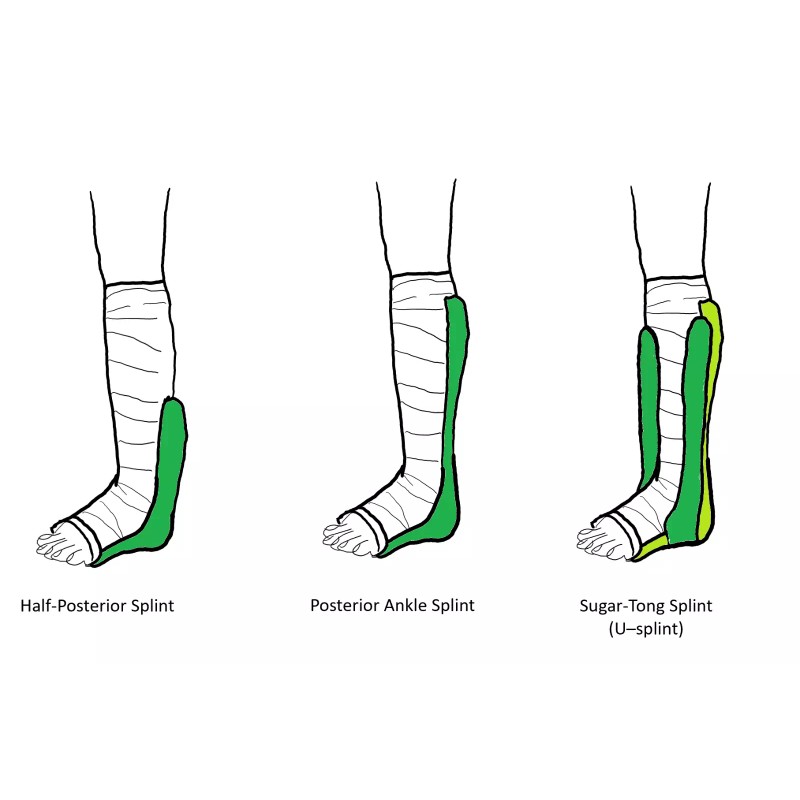 OrthoTape Fiberglass Stirrup Sprained Ankle Splint Kit | Materials make