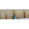 ISAL 3 Lot of ISAL Atopy Eczema Cream Lotion./Made in