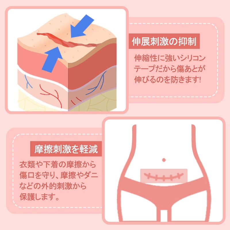 傷跡ケアテープ ケロイド テープ 傷あとケア用シリコンジェルシート 手術後 帝王切開 傷テープ 傷隠しテープ