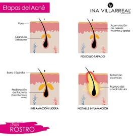 TÓNICO ANTI-MACHAS, CONTROL DE GRASA CON VINAGRE DE SIDRA Y TÉ VERDE
