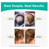 Set De Champú Y Acondicionador Shapiro Md Hair Loss 1