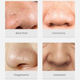 Crema para Remover Puntos Negros