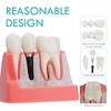 LVCHEN Modelo de implante dental – 4 veces corona puente
