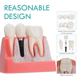 LVCHEN Modelo de implante dental – 4 veces corona puente explicación modelo de análisis de implante modelo de diente de corona extraíble demostración de sección transversal para estudio y enseñanza