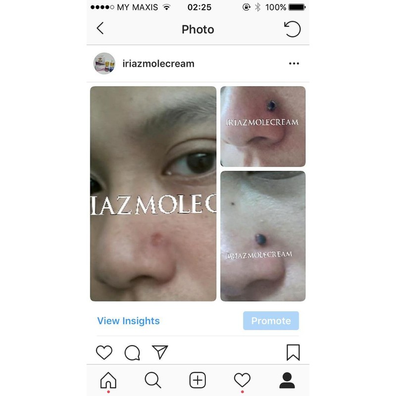 IRIAZ MOLE CREAM BUANG TAHI LALAT KUTIL BIJI KOLESTEROL