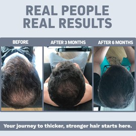 Foli-Tonic DHT Blocker & Hair Loss Supplement | Hair Thinning Treatment & Promotes Healthy Thicker Hair Growth (60 Count (Pack of 1))