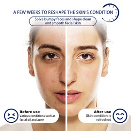 Acne Foaming Wash Akne Schaumwäsche, Reinigungsschaum Gesichtsreinigungsschaum Beruhigender Reinigungsschaum für Tägliche Hautreinigung facial cleanser B