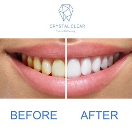 Crystal Clear Teeth Whitening Kit de Gel Blanqueador de Dientes Crystal Clear - aprobado por los dentistas