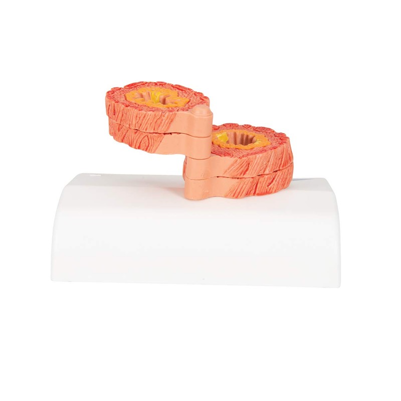 3B Scientific Human Anatomy - COPD Model + Free Anatomy