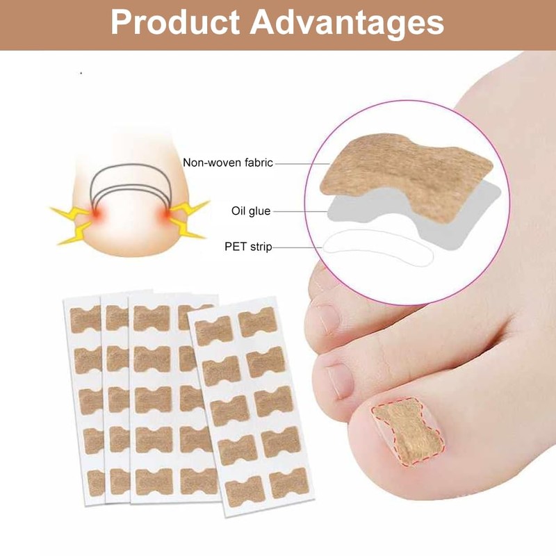 Ingrown Toenails Set, Toenail Correction, Toenail Patch, Toenail Correction Patch,
