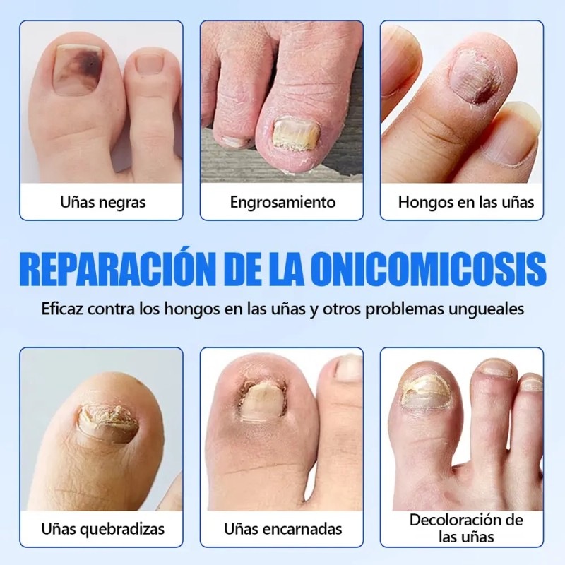 Parches Para Uñas Fúngicos 63pzs Caja De Parches Dañadas