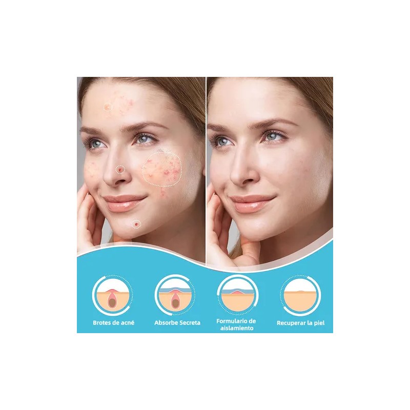 Lusabe Parches Para Acn Invisibles 36pzs Pimple Patch