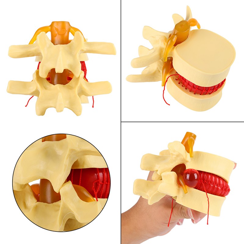 1:1.5 Anatomical Medical Human Spine Lumbar Disc Herniation Demonstration Model