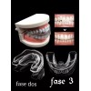 Trainer 3 Fases Dentales Bruxismo Tratamiento Completo