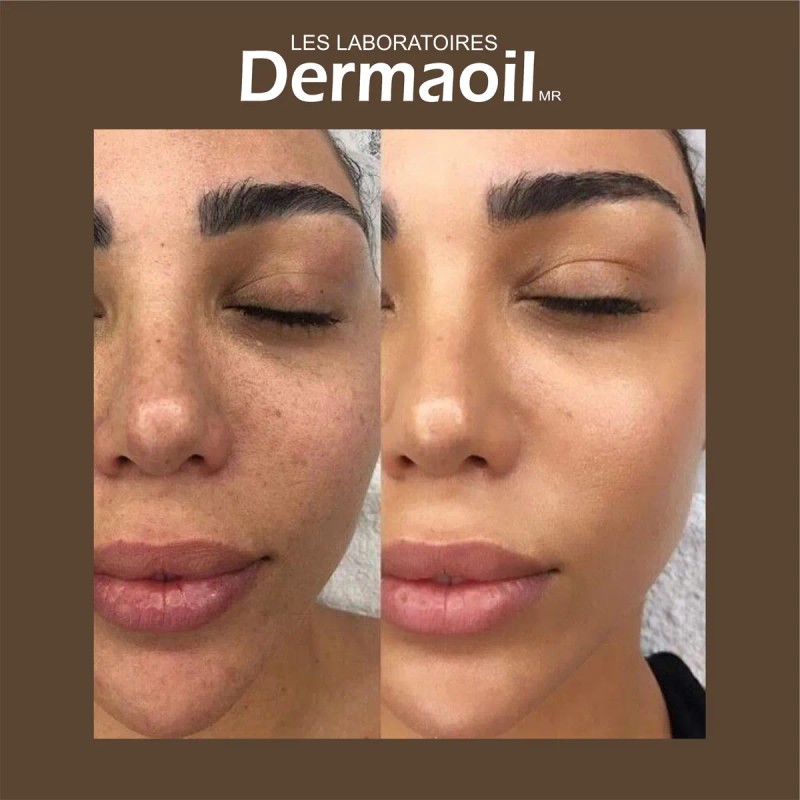 Tratamiento Avanzado Y Completo Para Melasma ( Paño )